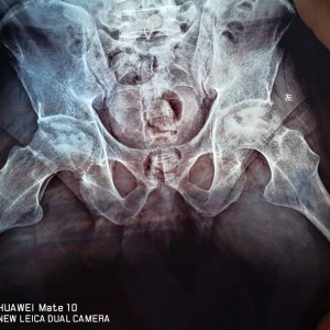 一例典型的股骨头坏死患者的X片、CT、磁共振影像