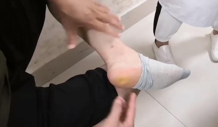 这一种足跟痛，不是足跟的问题，而是踝管综合征